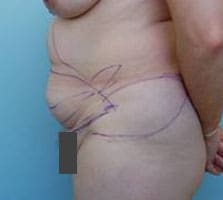 Tummy Tuck (Anterior Torsoplasty) Before and After Pictures Columbia, SC