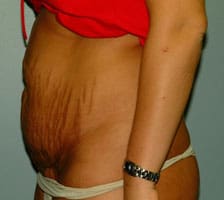 Tummy Tuck (Anterior Torsoplasty) Before and After Pictures Columbia, SC