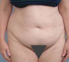 Tummy Tuck (Anterior Torsoplasty) Before and After Pictures Columbia, SC