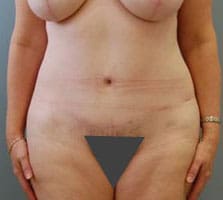 Tummy Tuck (Anterior Torsoplasty) Before and After Pictures Columbia, SC