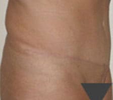 Tummy Tuck (Anterior Torsoplasty) Before and After Pictures Columbia, SC