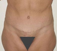 Tummy Tuck (Anterior Torsoplasty) Before and After Pictures Columbia, SC