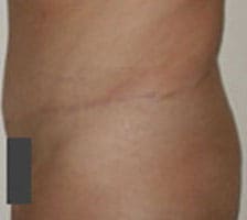 Tummy Tuck (Anterior Torsoplasty) Before and After Pictures Columbia, SC