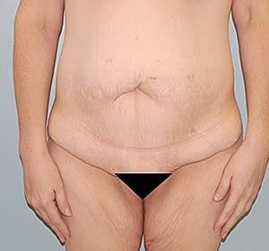 Tummy Tuck (Anterior Torsoplasty) Before and After Pictures Columbia, SC