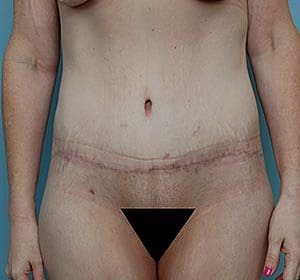 Tummy Tuck (Anterior Torsoplasty) Before and After Pictures Columbia, SC