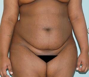 Tummy Tuck (Anterior Torsoplasty) Before and After Pictures Columbia, SC