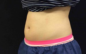 CoolSculpting® Before and After Pictures Columbia, SC