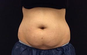 CoolSculpting® Before and After Pictures Columbia, SC