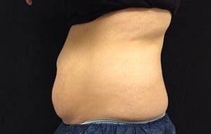 CoolSculpting® Before and After Pictures Columbia, SC