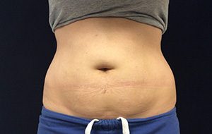 CoolSculpting® Before and After Pictures Columbia, SC