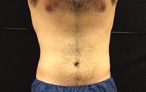 CoolSculpting® Before and After Pictures Columbia, SC