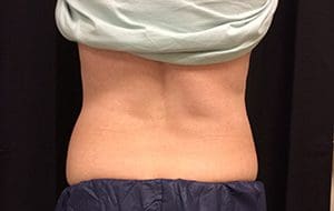 CoolSculpting® Before and After Pictures Columbia, SC