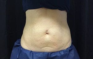 CoolSculpting® Before and After Pictures Columbia, SC