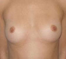 Transaxillary Subpectoral Augmentation Before and After Pictures Columbia, SC