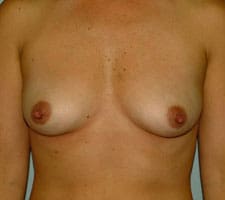 Breast Augmentation Before and After Pictures Columbia, SC
