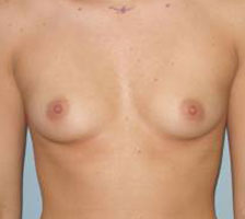 Breast Augmentation Before and After Pictures Columbia, SC