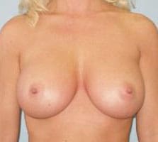 Breast Augmentation Before and After Pictures Columbia, SC