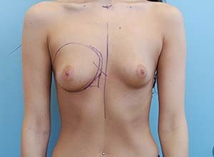 Transaxillary Subpectoral Augmentation Before and After Pictures Columbia, SC