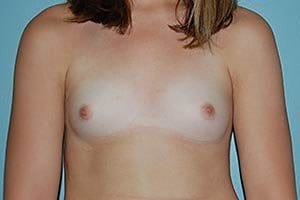 Complex Breast Surgery Before and After Pictures Columbia, SC