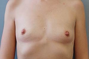 Transaxillary Subpectoral Augmentation Before and After Pictures Columbia, SC