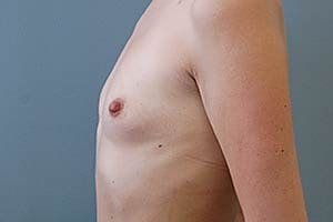 Transaxillary Subpectoral Augmentation Before and After Pictures Columbia, SC