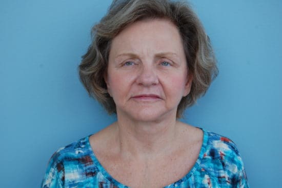 Facelift Before and After Pictures Columbia, SC