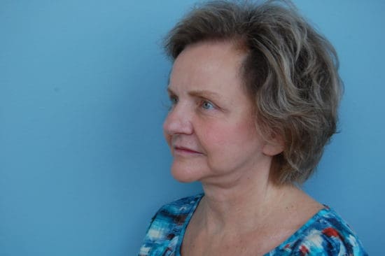 Facelift Before and After Pictures Columbia, SC