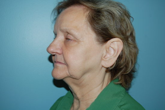 Facelift Before and After Pictures Columbia, SC