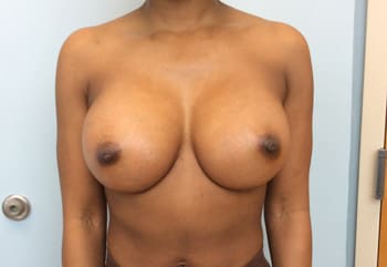 Breast Augmentation Before and After Pictures Columbia, SC