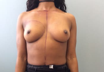 Breast Augmentation Before and After Pictures Columbia, SC