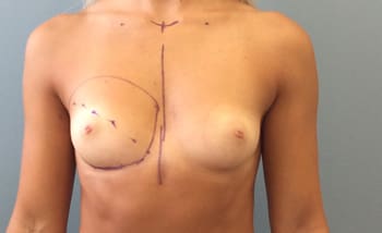 Breast Augmentation Before and After Pictures Columbia, SC