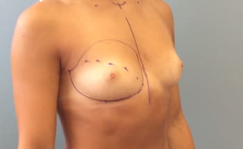 Breast Augmentation Before and After Pictures Columbia, SC