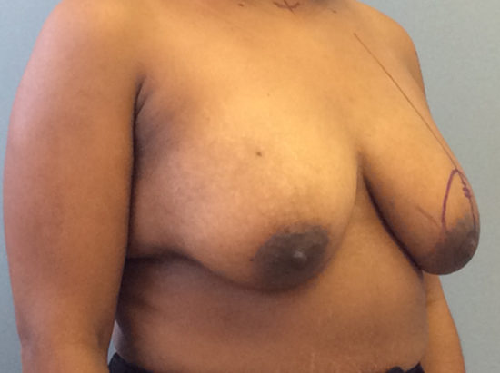 Breast Lift Before and After Pictures Columbia, SC