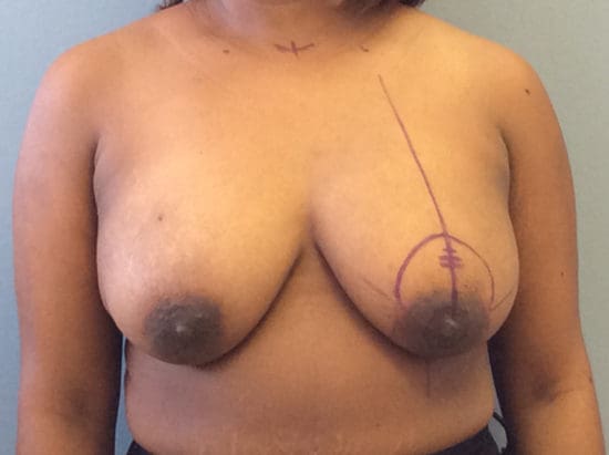 Breast Lift Before and After Pictures Columbia, SC