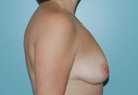 Breast Lift Before and After Pictures Columbia, SC