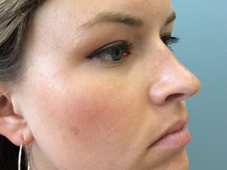 Rhinoplasty Before and After Pictures Columbia, SC