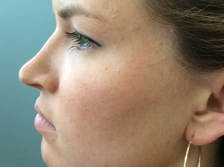 Rhinoplasty Before and After Pictures Columbia, SC