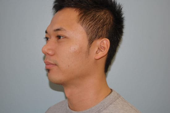 Rhinoplasty Before and After Pictures Columbia, SC