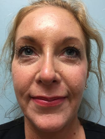 Rhinoplasty Before and After Pictures Columbia, SC