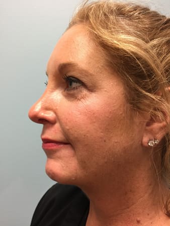 Rhinoplasty Before and After Pictures Columbia, SC