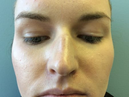 Rhinoplasty Before and After Pictures Columbia, SC