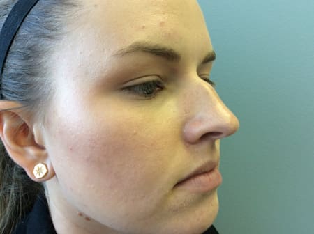 Rhinoplasty Before and After Pictures Columbia, SC