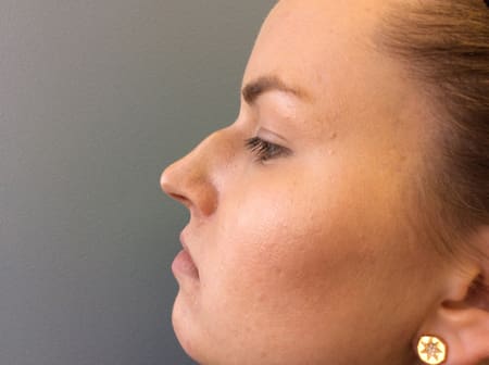 Rhinoplasty Before and After Pictures Columbia, SC