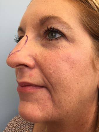 Rhinoplasty Before and After Pictures Columbia, SC