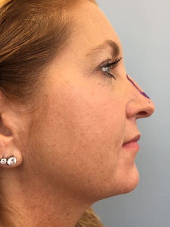 Rhinoplasty Before and After Pictures Columbia, SC