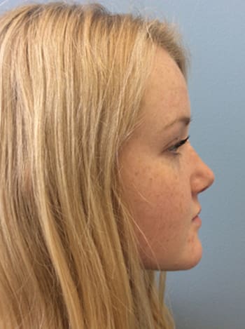 Rhinoplasty Before and After Pictures Columbia, SC