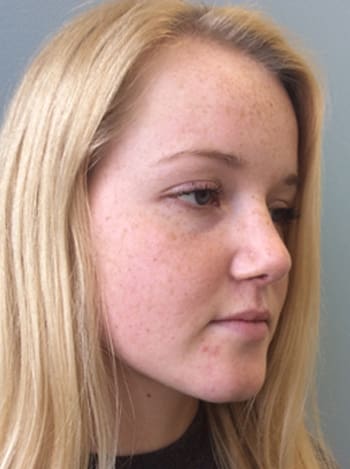 Rhinoplasty Before and After Pictures Columbia, SC