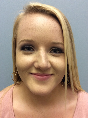 Rhinoplasty Before and After Pictures Columbia, SC