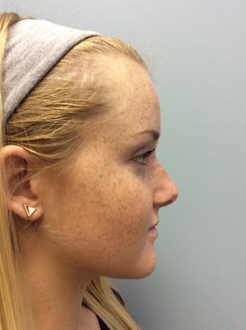 Rhinoplasty Before and After Pictures Columbia, SC