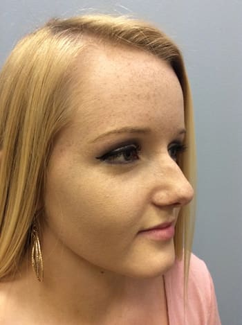 Rhinoplasty Before and After Pictures Columbia, SC